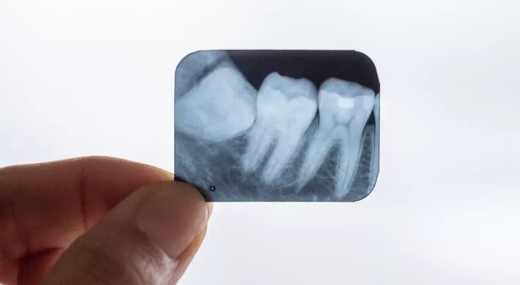 An X-Ray of wisdom teeth